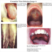 Virus nguy hiểm gây bệnh đường tiêu hóa có thể khiến trẻ tử vong